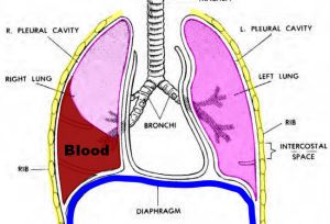 hemothorax1